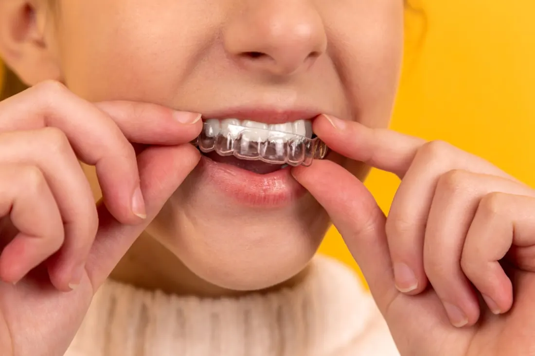 A patient seating a clear aligner